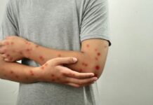 Mpox volta ao noticiário após novos casos no Brasil: o que está acontecendo?