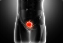 Estudo identifica microplásticos em 90% de tumores de próstata analisados